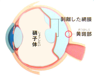 硝子体手術 硝子体手術写真
