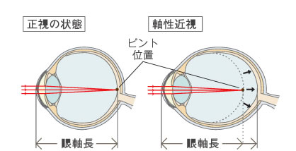 近視の進行と眼軸長の伸展画像