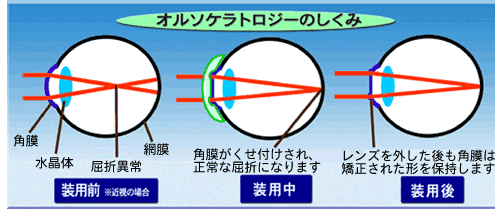 オルソ・ケラトロジーのしくみ オルソ・ケラトロジーのしくみ画像